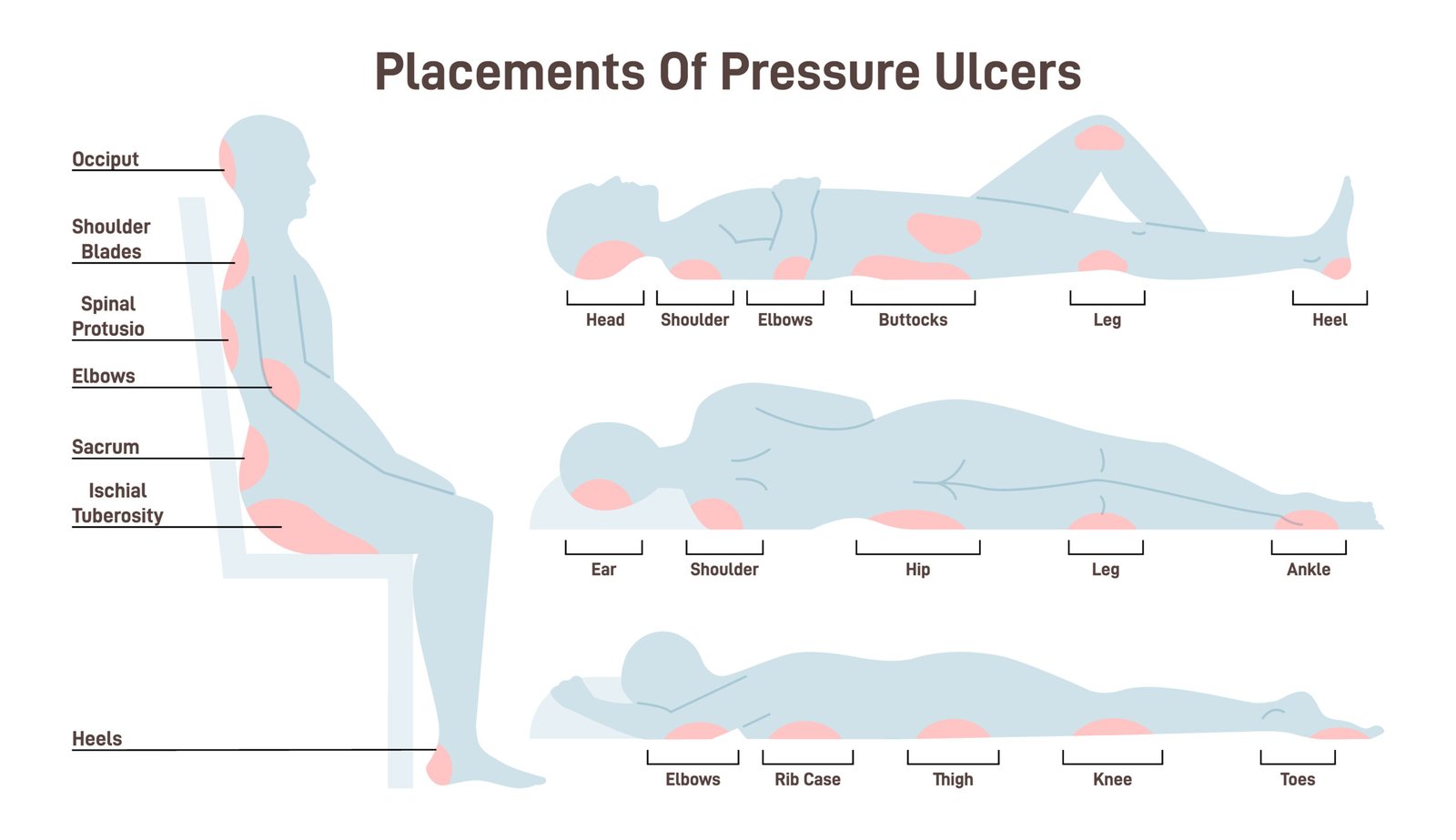 common locations of pressure ulcers