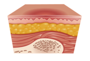 stage 1 pressure ulcer